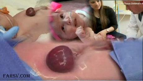 نوزادی با قلب خارج از بدن در آمریکا متولد شد